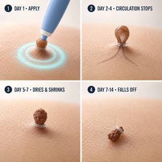 Vamiyo™ Skintag Removal Kit