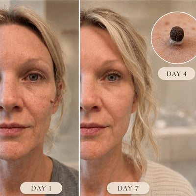 Vamiyo™ Skintag Removal Kit